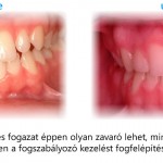 Szmicsek Dental Fogszabályozás előtte utána