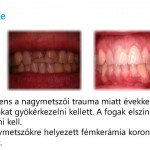Szmicsek Dental Fémkerámia korona