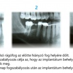 Szmicsek Dental Implantátum behelyezése