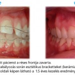 Szmicsek Dental Esztétikus Fogszabályozás előtte utána