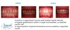 Szmicsek Dental Fémkerámia korona