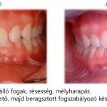 Szmicsek Dental Fogszabályozás előtte utána