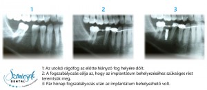 Szmicsek Dental Implantátum behelyezése